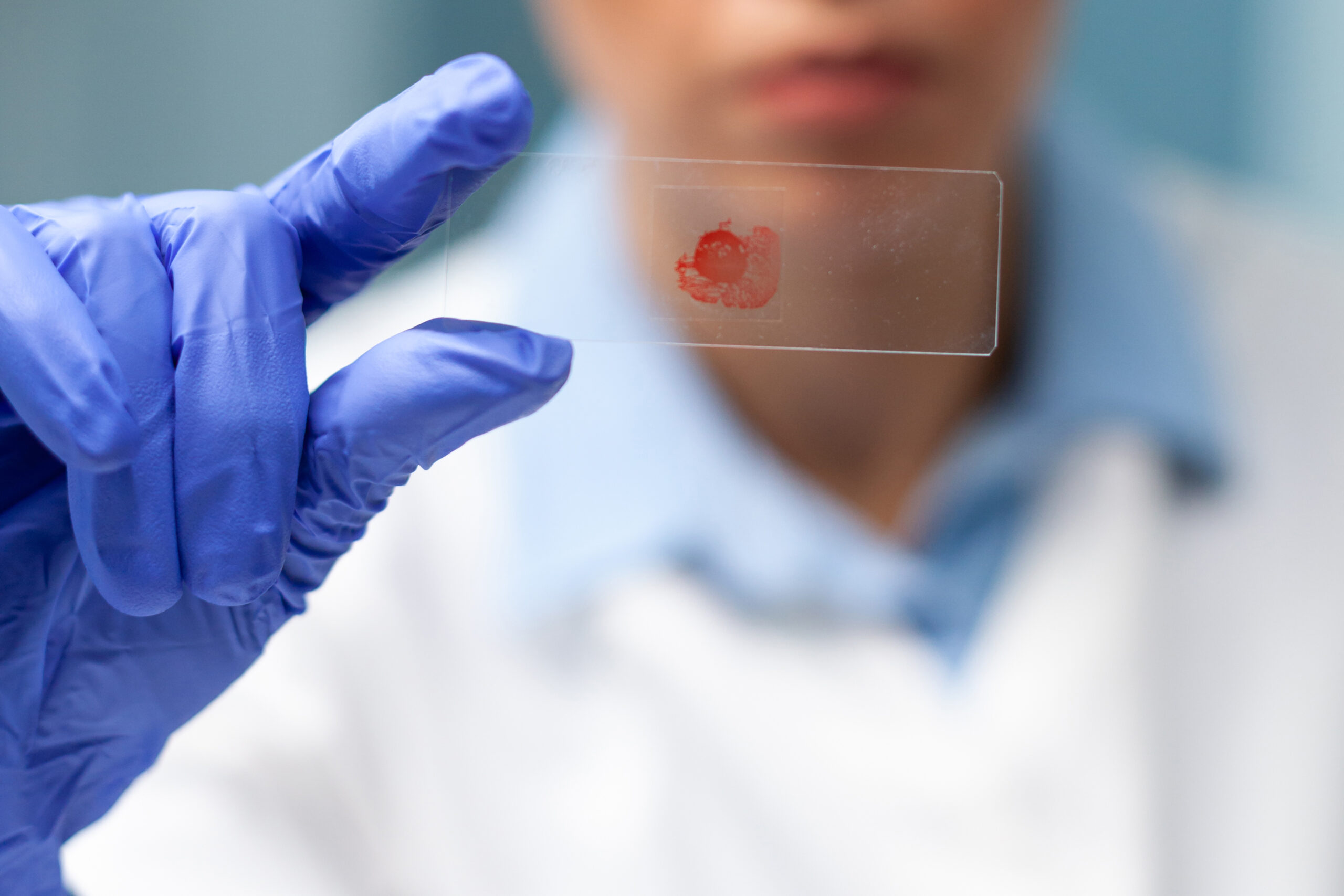 Beware Sepsis – Think Sepsis